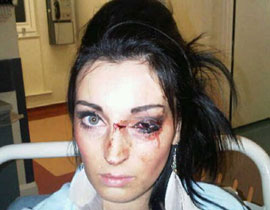 السجن للاعب روكبي لكم فتاة وتسبب لها باضرار قبيل زفافها! صورة رقم 1