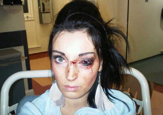 السجن للاعب روكبي لكم فتاة وتسبب لها باضرار قبيل زفافها! صورة رقم 2