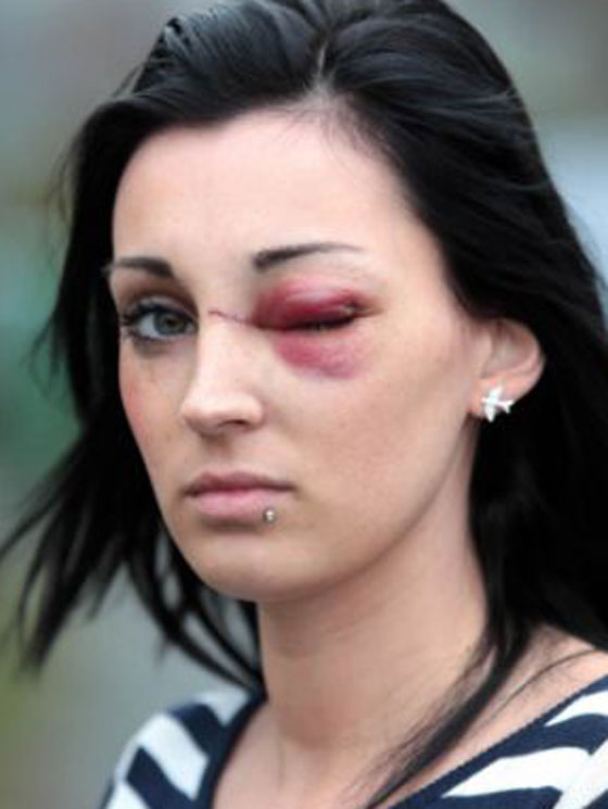 السجن للاعب روكبي لكم فتاة وتسبب لها باضرار قبيل زفافها! صورة رقم 3