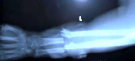 دموع أمريكي دفعت الطبيب لإعادة وصل ذراعه المقطوعة!!  صورة رقم 6