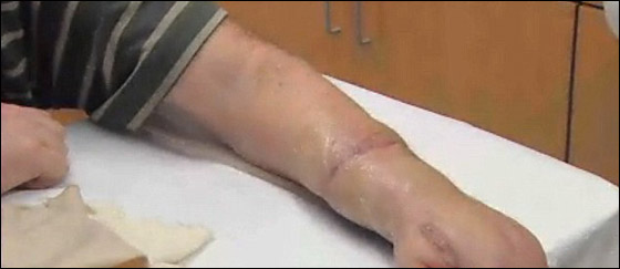 دموع أمريكي دفعت الطبيب لإعادة وصل ذراعه المقطوعة!!  صورة رقم 5