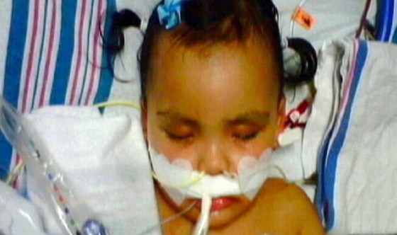 اهمال الاطباء ومماطلة العلاج أدى الى إعاقة طفلة وبتر اطرافها!! صورة رقم 2