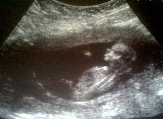 ابلغها الأطباء ان طفلتها توفيت بداخلها وتبين لاحقا انها حية  صورة رقم 6