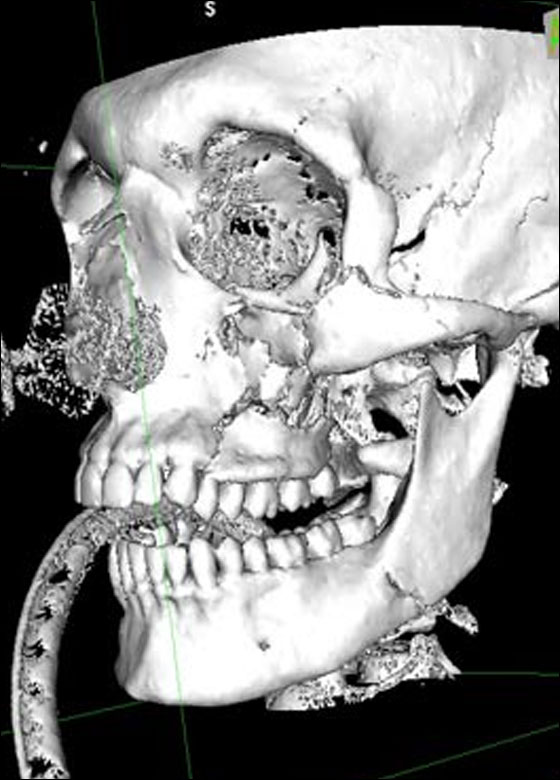 بريطاني يتماثل للشفاء بعد ان تحطمت جمجمته لـ 30 قطعة!!  صورة رقم 3