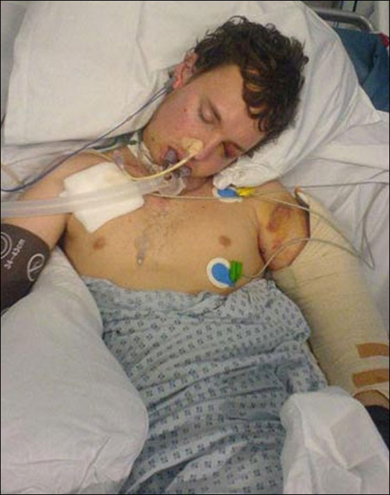 بريطاني يتماثل للشفاء بعد ان تحطمت جمجمته لـ 30 قطعة!!  صورة رقم 2