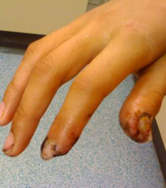 قنبلة خاملة تنفجر في طالب يهوى جمع الأسلحة! صورة رقم 2 قنبلة خاملة تنفجر في طالب يهوى جمع الأسلحة! صورة رقم 2