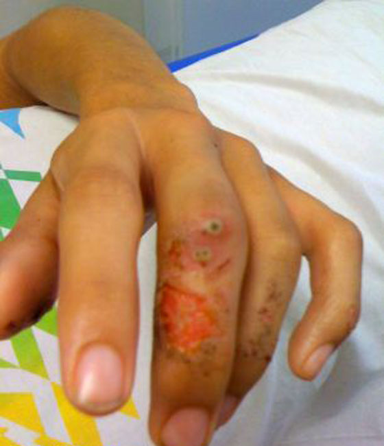 قنبلة خاملة تنفجر في طالب يهوى جمع الأسلحة! صورة رقم 3 قنبلة خاملة تنفجر في طالب يهوى جمع الأسلحة! صورة رقم 3