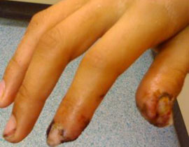 قنبلة خاملة تنفجر في طالب يهوى جمع الأسلحة! صورة رقم 1 قنبلة خاملة تنفجر في طالب يهوى جمع الأسلحة! صورة رقم 1