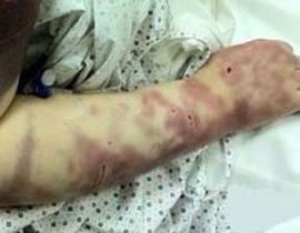 سعودية تعرضت للضرب بالمفك لمدة 11 ساعة من قبل زوجها! صورة رقم 1