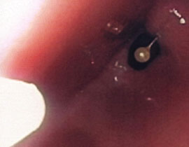 اخصائيو شنايدر يقومون باخراج ابرة من جدار معدة مراهقة في الـ 17! صورة رقم 1