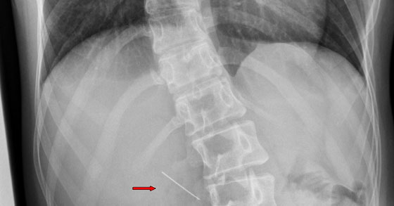اخصائيو شنايدر يقومون باخراج ابرة من جدار معدة مراهقة في الـ 17! صورة رقم 2