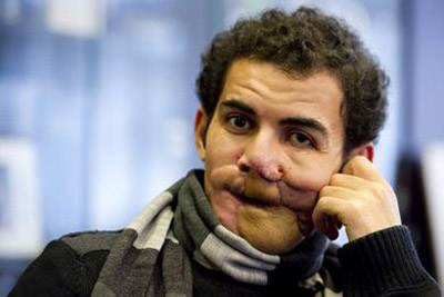 زراعة نصف وجه لشاب ليبي اصيب في احداث الثورة!  صورة رقم 3