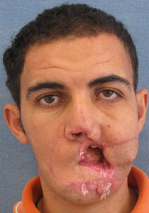 زراعة نصف وجه لشاب ليبي اصيب في احداث الثورة!  صورة رقم 1