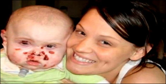 وفاة طفل بين ذراعي امه بعد صراع مع مرض جلد تركه مشوها!  صورة رقم 3
