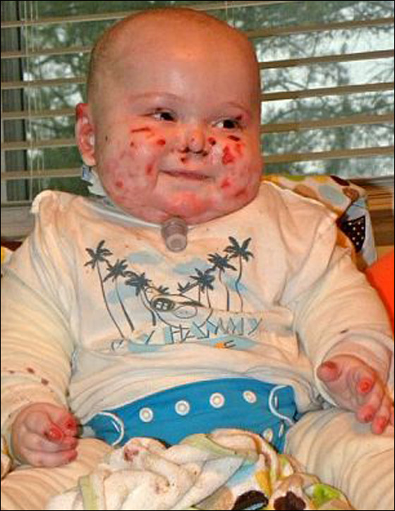 وفاة طفل بين ذراعي امه بعد صراع مع مرض جلد تركه مشوها!  صورة رقم 13