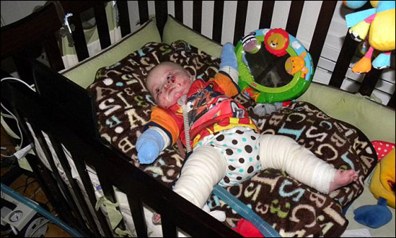 وفاة طفل بين ذراعي امه بعد صراع مع مرض جلد تركه مشوها!  صورة رقم 6