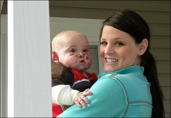 وفاة طفل بين ذراعي امه بعد صراع مع مرض جلد تركه مشوها!  صورة رقم 16