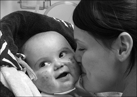 وفاة طفل بين ذراعي امه بعد صراع مع مرض جلد تركه مشوها!  صورة رقم 9