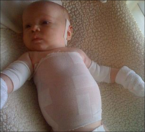 وفاة طفل بين ذراعي امه بعد صراع مع مرض جلد تركه مشوها!  صورة رقم 10