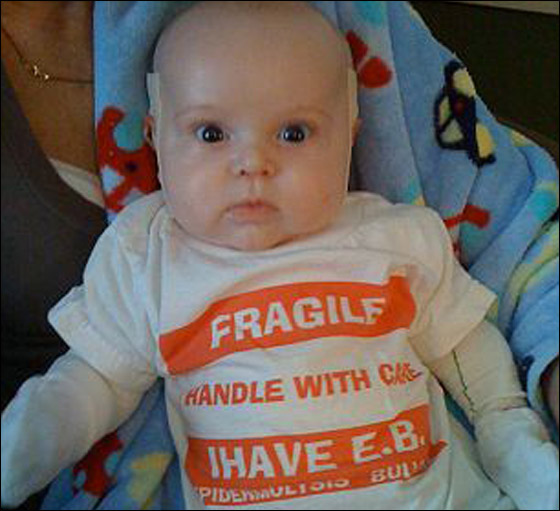 وفاة طفل بين ذراعي امه بعد صراع مع مرض جلد تركه مشوها!  صورة رقم 15