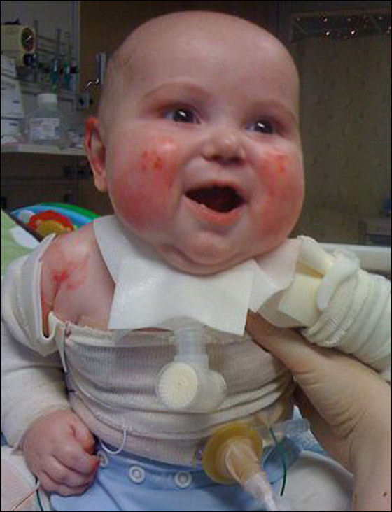 وفاة طفل بين ذراعي امه بعد صراع مع مرض جلد تركه مشوها!  صورة رقم 14