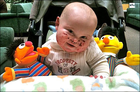 وفاة طفل بين ذراعي امه بعد صراع مع مرض جلد تركه مشوها!  صورة رقم 11