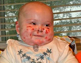 وفاة طفل بين ذراعي امه بعد صراع مع مرض جلد تركه مشوها!  صورة رقم 1