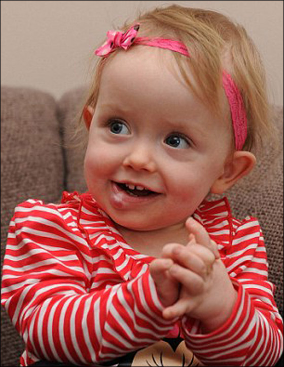 طفلة تبتسم لأول مرة بعد ازالة وحمة شوّهت وجهها!  صورة رقم 3