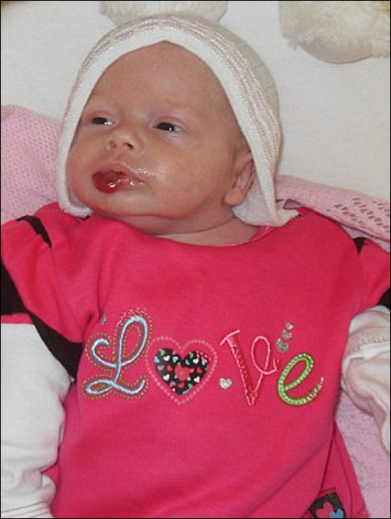 طفلة تبتسم لأول مرة بعد ازالة وحمة شوّهت وجهها!  صورة رقم 4