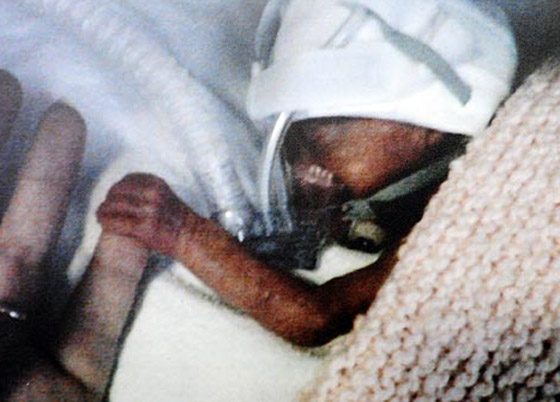 انقاذ حياة رضيعة بحجم التفاحة بوضعها بكيس بلاستيك للسندوتشات صورة رقم 2