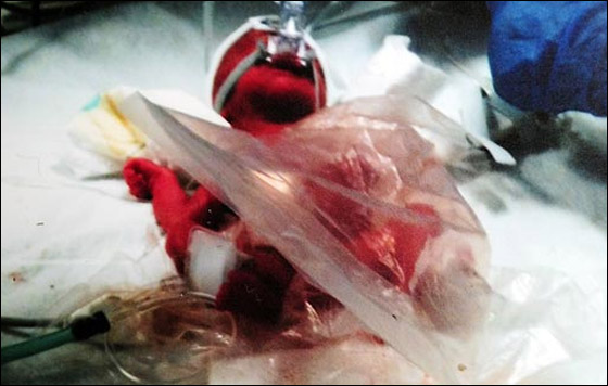 انقاذ حياة رضيعة بحجم التفاحة بوضعها بكيس بلاستيك للسندوتشات صورة رقم 4