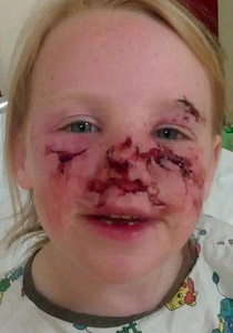 كلب فرنسي شرس يهاجم طفلة وينهش ويشوه وجهها!! صورة رقم 1