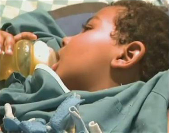 جراحة نادرة لطفل العامين لا يتوقف عن الضحك بسبب ورم في المخ! صورة رقم 2