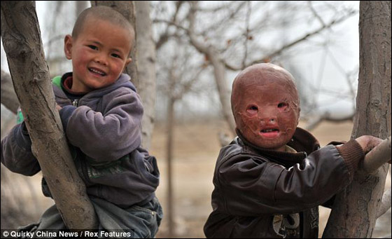 بالصور.. طفل صيني يرتدي قناعا من الندب والحروق لا يستطيع خلعه صورة رقم 2 بالصور.. طفل صيني يرتدي قناعا من الندب والحروق لا يستطيع خلعه صورة رقم 2