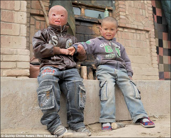 بالصور.. طفل صيني يرتدي قناعا من الندب والحروق لا يستطيع خلعه صورة رقم 3 بالصور.. طفل صيني يرتدي قناعا من الندب والحروق لا يستطيع خلعه صورة رقم 3