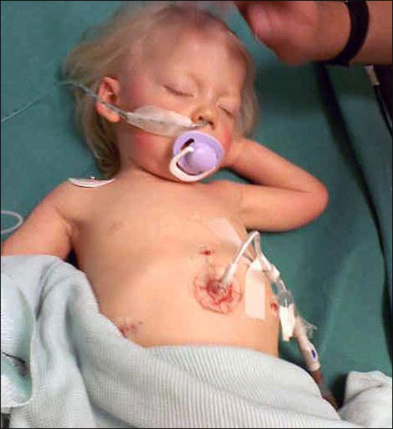 مرض نادر يحول أعضاء طفلتين لكريستال ويهددهما بالفشل الكلوي! صورة رقم 5