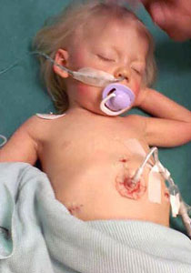 مرض نادر يحول أعضاء طفلتين لكريستال ويهددهما بالفشل الكلوي! صورة رقم 1