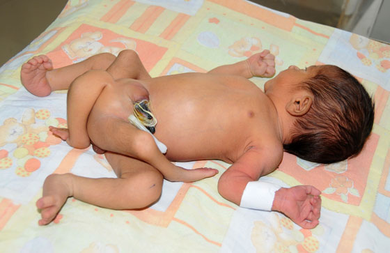 عملية ازالة 4 ارجل اضافية لطفل باكستاني تتكلل بالنجاح!  صورة رقم 4