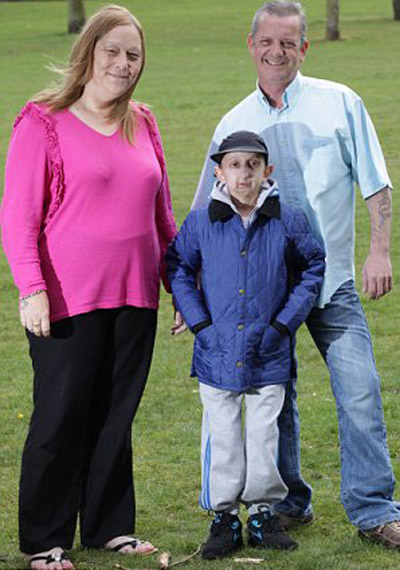 شيخوخة نادرة تصيب شاب بريطاني وتجعله يبدو في 160 من عمره! صورة رقم 9