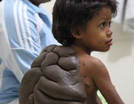 في حالة نادرة: استئصال الورم الضخم من ظهر 