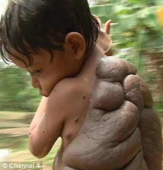 في حالة نادرة: استئصال الورم الضخم من ظهر 