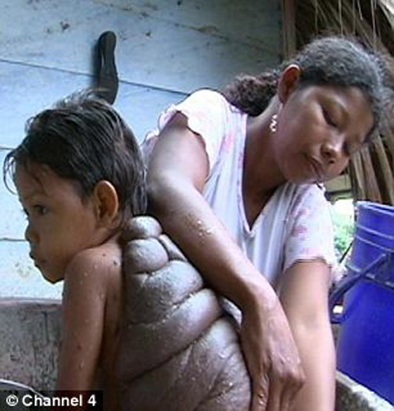 في حالة نادرة: استئصال الورم الضخم من ظهر 