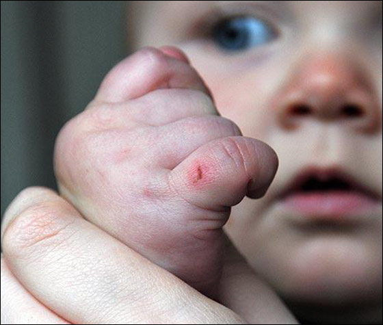 نمس جائع يهاجم طفلة في عربتها ويقضم اصبعها! صورة رقم 1 نمس جائع يهاجم طفلة في عربتها ويقضم اصبعها! صورة رقم 1