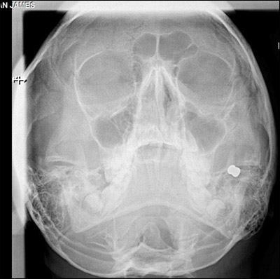 رصاصة تصيب الاعصاب الرئيسية لوجه طالب وتحرمه من الابتسامة صورة رقم 3