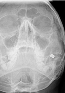 رصاصة تصيب الاعصاب الرئيسية لوجه طالب وتحرمه من الابتسامة صورة رقم 1