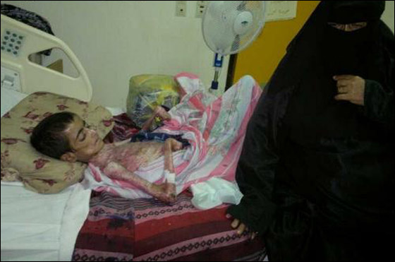 بالصور: شاب أصيب بمرض نادر حوله الى هيكل عظمي! صورة رقم 1