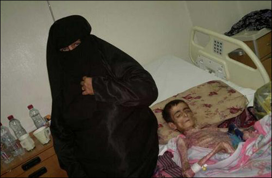 بالصور: شاب أصيب بمرض نادر حوله الى هيكل عظمي! صورة رقم 2