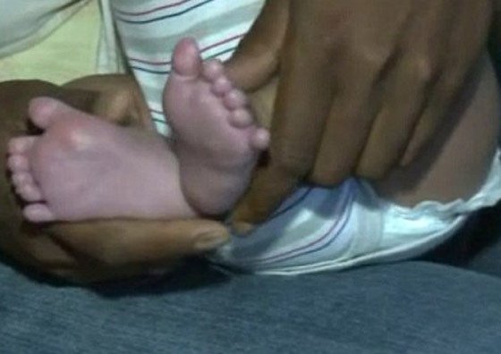 بالصور: في حالة نادرة.. طفل يولد بـ12 اصبع في قدميه! صورة رقم 3 بالصور: في حالة نادرة.. طفل يولد بـ12 اصبع في قدميه! صورة رقم 3