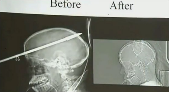 معجزة حقيقية: نجاة مراهق من الموت بعد أن اخترق رمح جمجمته صورة رقم 3