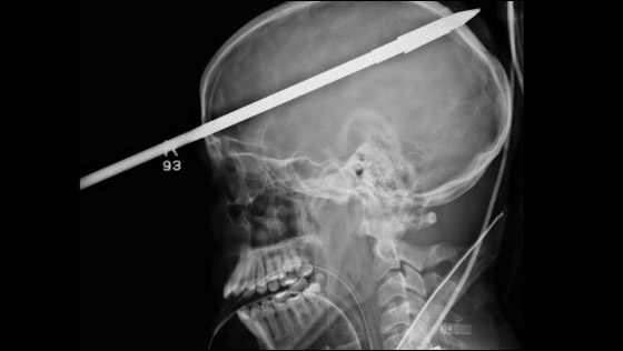 معجزة حقيقية: نجاة مراهق من الموت بعد أن اخترق رمح جمجمته صورة رقم 2